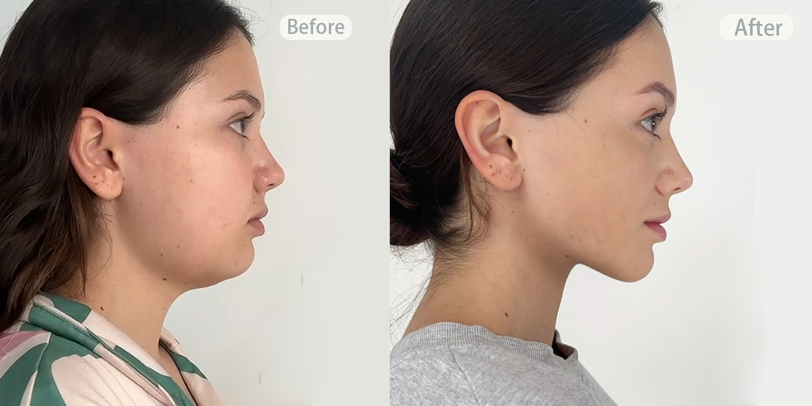 Before and After Photos of Face Yoga