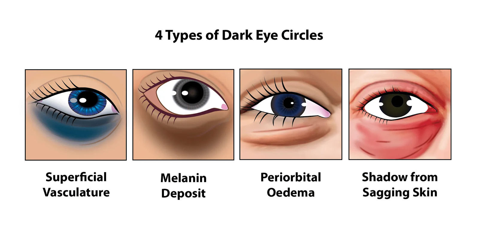 4 types of dark circles under your eyes